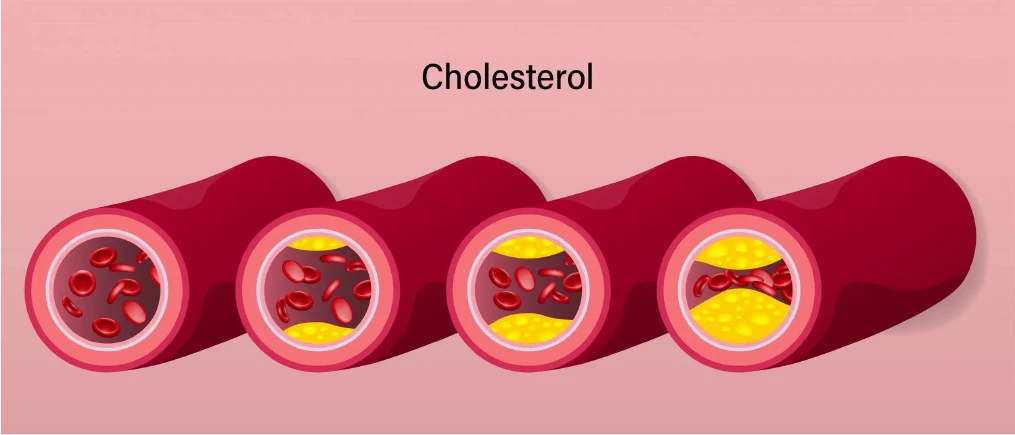 コレステロールが高くなるにつれての血管内の変化（イラスト）